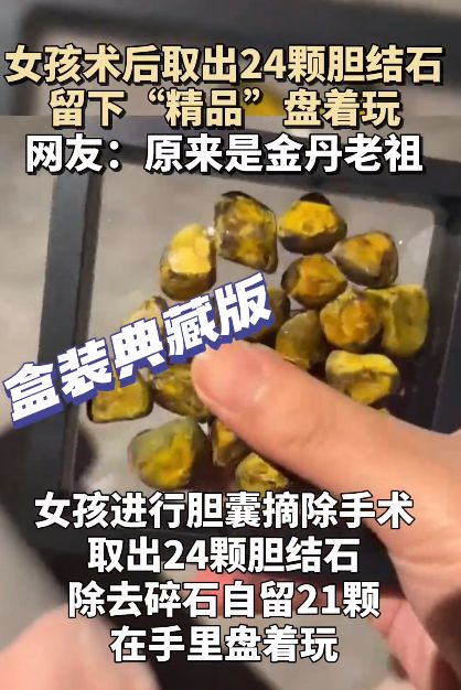 女生取24颗胆结石:没事盘着玩! 第1张 女生取24颗胆结石:没事盘着玩! 第1张